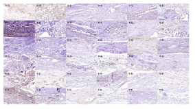 Immunohistochemical staining results of Osteoprotegerin (OPG) (× 40)
