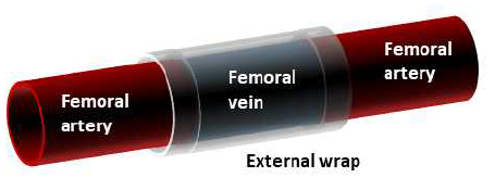 Vein to artery graft 부위를 형상기억 고분자를 이용하여 포장한 모식도