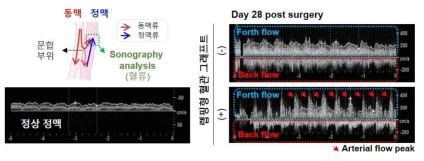 랩핑형 혈관 그래프트로 인한 혈관 개통성과 와류 형성 확인을 위한 초음파 검사