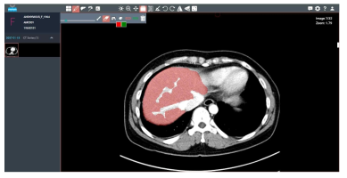 GoCDSS GUI, 간섬유화(fibrosis) 진단을 위한 간위치 관심구역(ROI) 선택기능