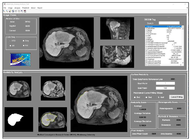 자기공명영상을 이용한 간표면 결절성(LSN) 정량화 예시 화면