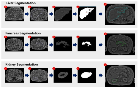 의료영상데이터의 장기별 세분화 적용 화면: 간, 췌장, 신장