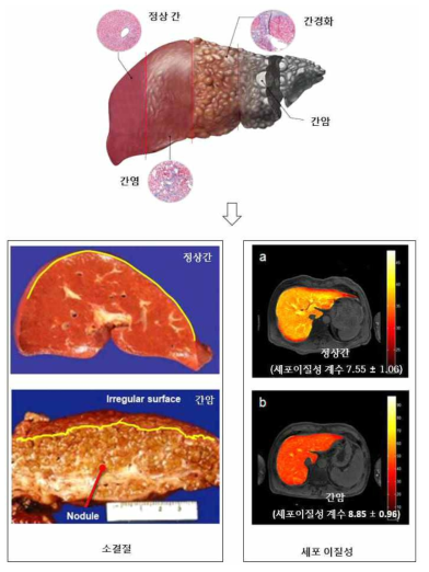 정량 분석된 간표면 소결절(LSN)과 세포이질성 점수의 임상적 의의 (출원 특허내용 발췌)