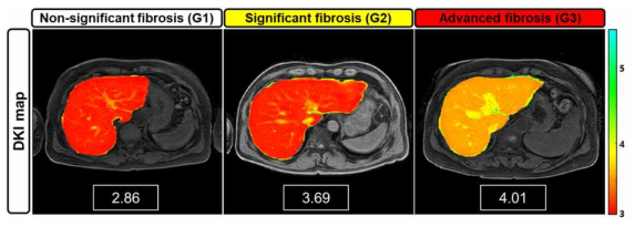 간섬유화 중증도별(G1-G3) 대표 커토시스맵 영상 (분류기준: APRI 점수)