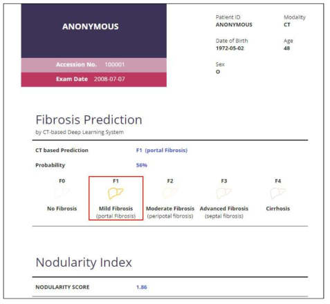 GoCDSS 진단 예측을 활용한 예시. 간섬유화 중증도는 F1, 간 결절 점수는 1.86임