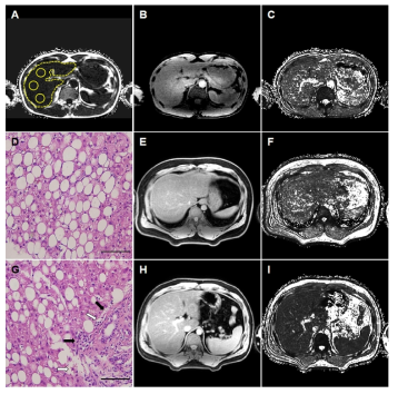 정상인(A-C), 단순지방증 (D-F), 지방간염(NASH) (G-I)를 대상으로 획득한 대표 T2* map 영상