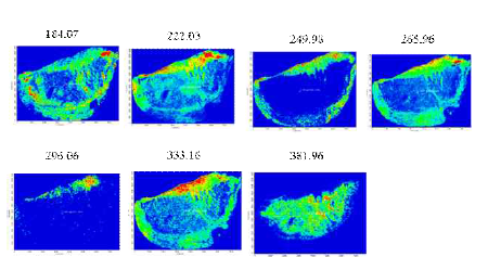 MALDI images of low mass-range metabolites generated from sections of surgically-removed melanoma cancer tissue samples