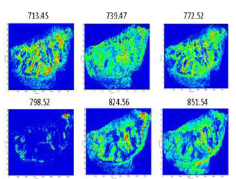 MALDI-MS images of high mass range metabolites obtained from sections of surgically-removed melanoma cancer tissue