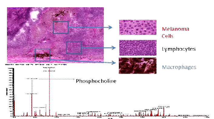 Tissue compartment representations within the isolated patient tumor