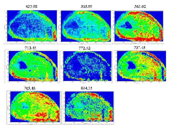 MALD-MS images from patient cancer tissue samples isolated after surgery. Metabolites were identified in: melanoma, lymphocyte and macrophage cells