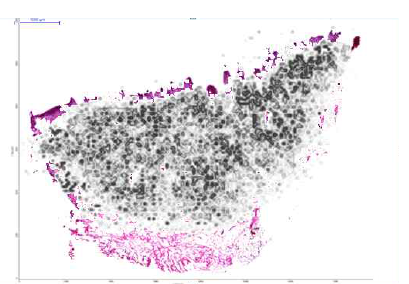 Counter plot of the MALDI-MS image overlaid with the histological stained sections from patient cancer tissue