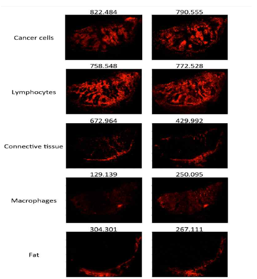 MALDI-MSI of patient tumor tissue isolated after surgery. Endogenous, low molecular weight compounds were analyzed. Images show the tissue distribution of selected masses that correspond to the various tissue compartments, such as melanoma cells, lymphocytes, macrophages, connective tissue and fat. A specific mask plane was used to query corresponding masses for each investigated region