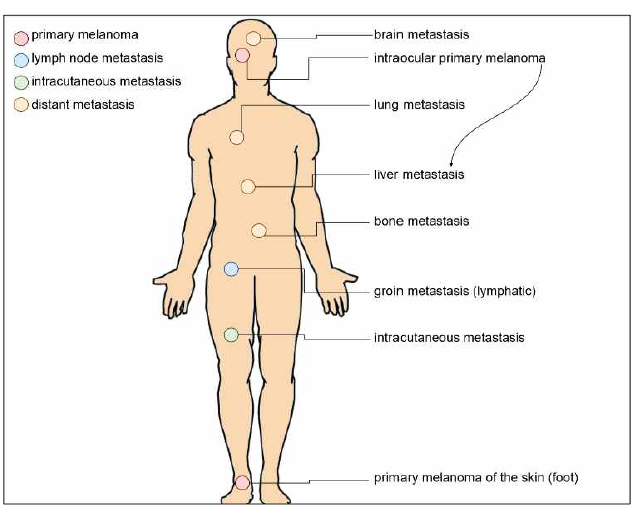 Tumour metastasis mapping of patients in our biobank repository