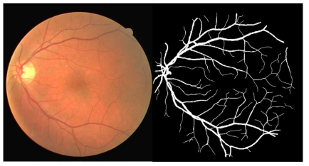 DRIVE database에 포함된 망막안저사진 및 해당하는 망막혈관분할영상 예시. 망막안저사진의 해상도가 낮고, 망막혈관분할영상이 정확하지 않은 것을 알 수 있으며, 작은 혈관들은 생략되어있거나, 위치가 잘 못되어있는 것을 알 수 있음