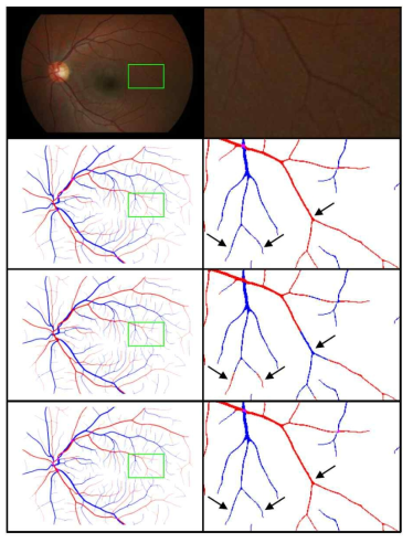 본 연구진이 구축한 1000 set의 ground truth 영상(첫 번째 열의 안저사진 + 두 번째 열의 혈관추출영상 및 동/정맥 분류 영상), 기존 CNN 기반 동정맥분류의 결과(세 번째 열), 본 연구진이 제안한 Graph Neural Network(GNN)를 같이 이용한 Joint Deep Learning의 결과. CNN 결과도 pixel 기반으로 판단 시 좋은 성능을 보이나, 혈관 주행 중 분류가 바뀌는 일이 빈번하게 발생함. GNN을 함께 사용하여 이를 줄일 수 있음