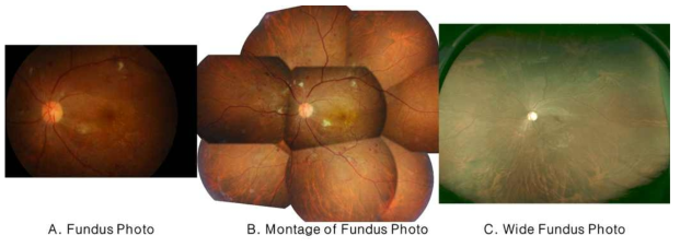 A는 일반적인 망막안저사진이다. (그림1 참고) 약 30-45° 망막안저영역 촬영이 가능하다. 안구를 돌려가며 주변부 영역을 촬영 가능하지만, 종합적인 판단이 어려워 이를 위해 임상의사가 직접 영상편집 프로그램을 이용하여 B와 같이 몽타주 (Montage) 영상을 빈번하게 생성한다. 최근 Optos사에서 SLO 방식의 레이저주사 및 스캔 후 영상을 재구성한후 pseudocolor를 입혀 180° 이상의 망막안저영역 촬영이 가능하나, 장비가 굉장히 고가이고 실제 영상이 아닌 재구성영상이라는 한계가 있다