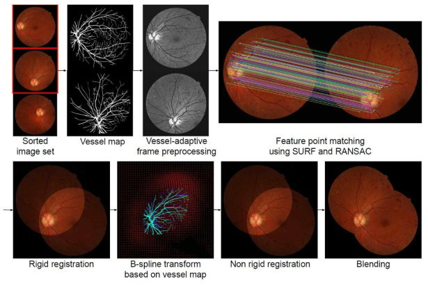 그림 15에서 제안한 방법론에서 개별 영상의 정합 방법에 대한 자세한 도해. Key point Matching을 통한 강직정합 (rigid registration)이후 추출된 망막혈관분할영상을 이용하여 비강직정합(non-rigid registration)을 시행하고, 이후 밝기, 대조, 색상 등에 대해서 보정을 수행함. (Kim et al. Applied Science. 2021)