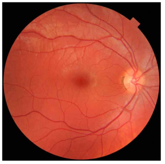 망막안저사진. 망막에서 발생하는 주요 질환들을 쉽게 진단할 수 있으며, 손쉽게 망막 및 정맥을 관찰하고 지표를 추출할 수 있음