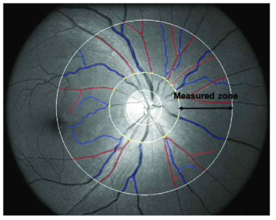 망막안저사진에서 여러 혈관지표(Vascular Index)를 구하는 모습. 동/정맥 구별 및 혈관 분할 작업 후 혈관지표를 산출에 시간과 노력이 많이 소요됨