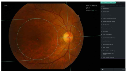 안과전문의가 라벨링을 위해 사용한 선행과제에서 개발한 Annotation Tool의 모습 (Park et al. JKMS. 2018)