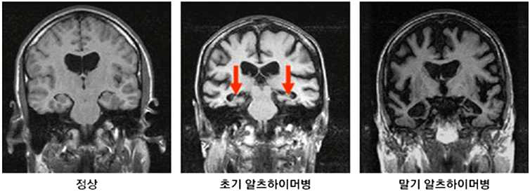 AD의 진행에 따른 MRI 사진 (출처: 보건복지부 중앙치매센터)