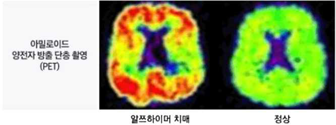 기능적 뇌이미징 검사 (출처 : 보건복지부 중앙치매센터)