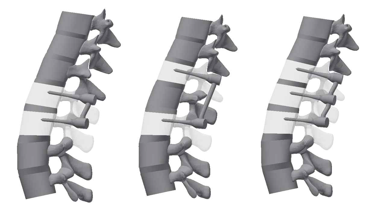 척추 고정 분절에 따른 3D 모델