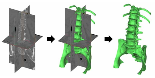 환자의 의료영상에서 척추골에 대한 3차원 모델을 추출하는 과정
