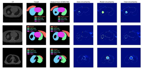 유방암 환자의 CT 영상, 의료진이 그린 contour (target), SCNAS-Net 으로부터 도출된 contour (output) 및 uncertainty maps