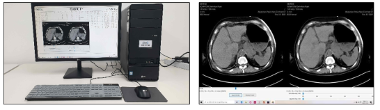 영상품질 개선 시스템(좌)과 CT영상 품질개선 (noise 제거) 지원 결과화면(우)