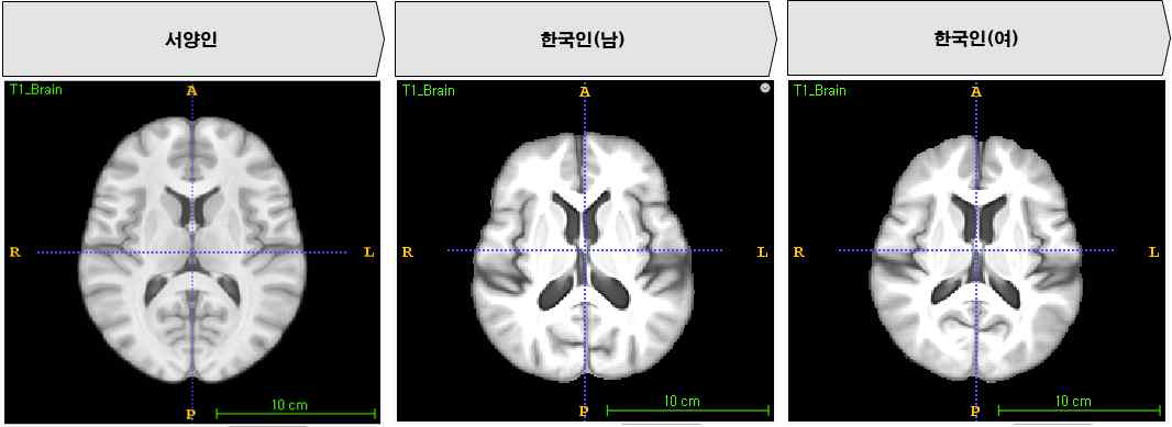 한국인과 서양인 뇌의 구조적인 차이