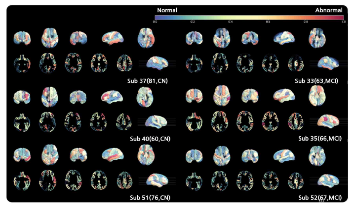 영역별 비정상도 특징 추출 알고리즘을 통한 정상군(Cognitively Normal, CN)과 경도인지장애(MCI) 아밀로이드- β negative 비정상도 가시화, 각 피험자(나이, 진단 상태)로 나타내며, 비정상에 가까울수록 빨간색, 정상에 가까울수록 파란색을 나타냄