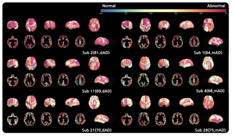 영역별 비정상도 특징 추출 알고리즘을 통한 치매 환자(mAD)와 (dementia Alzheimer’s Disease, dAD) 아밀로이드- β positive 비정상도 가시화, 각 피험자(나이, 진단 상태)로 나타내며, 비정상에 가까울수록 빨간색, 정상에 가까울수록 파란색을 나타냄