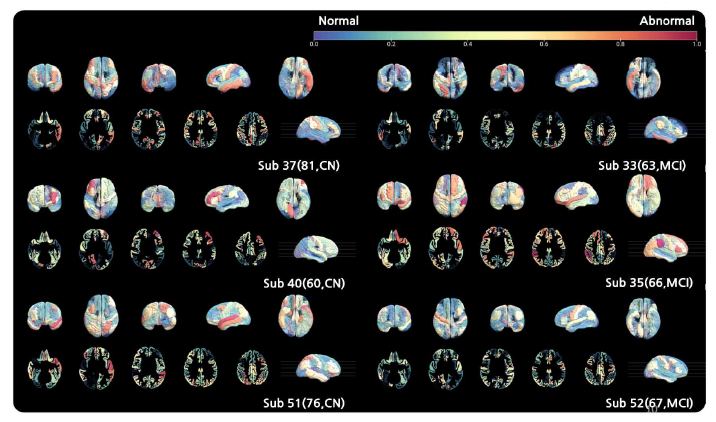 영역별 비정상도 특징 추출 알고리즘을 통한 정상군(Cognitively Normal, CN)과 경도인지장애(MCI) 아밀로이드- β negative 비정상도 가시화, 각 피험자(나이, 진단 상태)로 나타내며, 비정상에 가까울수록 빨간색, 정상에 가까울수록 파란색을 나타냄
