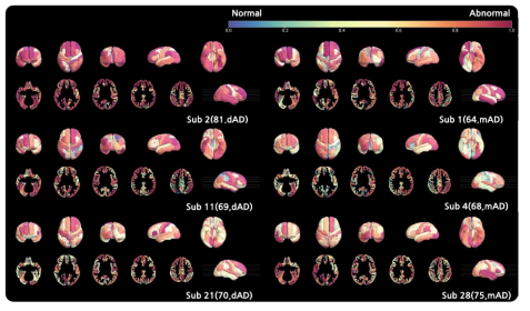 영역별 비정상도 특징 추출 알고리즘을 통한 치매 환자(mAD)와 (dementia Alzheimer’s Disease, dAD) 아밀로이드- β positive 비정상도 가시화, 각 피험자(나이, 진단 상태)로 나타내며, 비정상에 가까울수록 빨간색, 정상에 가까울수록 파란색을 나타냄