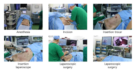 Laparoscopic surgery