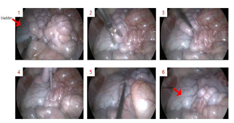 복강경을 통한 방광의 위치 확인 적용법에 대한 고찰