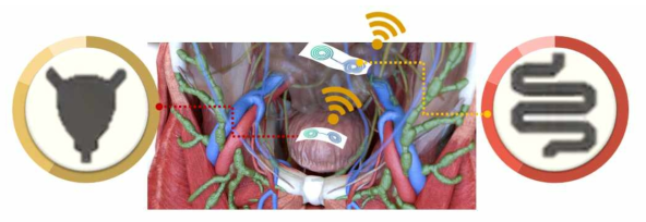 방광 및 장기와 대장의 표면에 부착이 가능한 시한성 무선 압력 센서