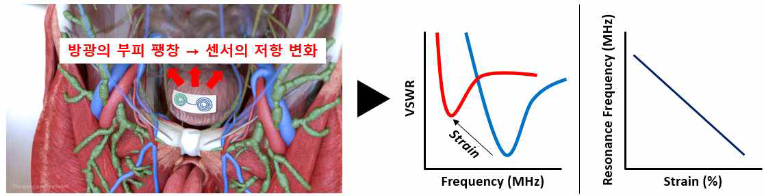 저유동성 장기(방광) 표면에 부착이 가능한 시한성 압력 센서의 예시