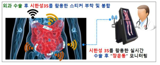 생체모사형 시한성 3S를 활용한 장마비 모니터링