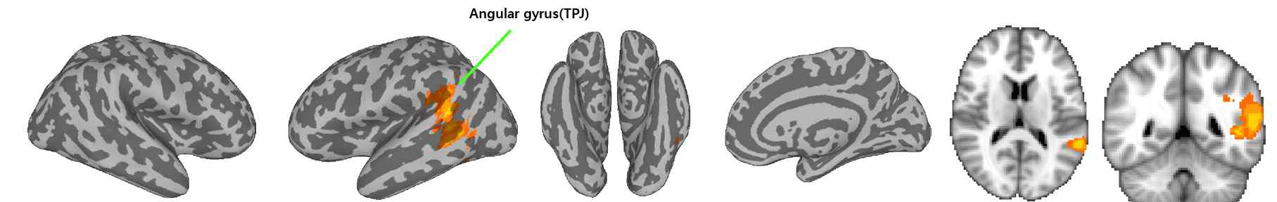 Difference map ([COVVAS-P_pneg-pneu] 대조군 전후 비교)