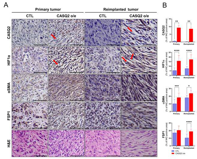1차 종양조직과 재이식 종양의 HIF1α와 암관련섬유아세포 특징 분석