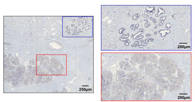 환자종양조직에서의 CASQ2 발현조사 (파랑색 상자: 정상세포, 빨간색 상자: 유방암세포)
