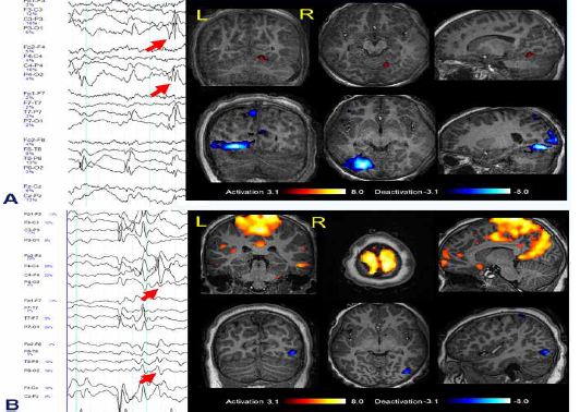 A) Panayiotopoulos syndrome 이 있는 환아에서 뇌파 소견과 EEG/fMRI소견, 왼쪽 후두엽에서 경련파가 관찰되며 maximum t-value 가 deactivation 으로 Left visual association cortex 에 나타났다. 기 예는 BOLD response 가 경련 발생 부위와 일치하면서도 위치 선정에 기여한 예가 된다. B) 다양한 경련파를 보이는 8 세 여아로 뇌파에서 right fronto-centro-temporal area 에 있는 경련파를 분석 하였다. maximum- t- value 가 right primary cortex 에 보여서 위치는 일치하나 범위가 넓어 좀 더 국소의 경련 발생 부위 위치를 제공하지는 못했다