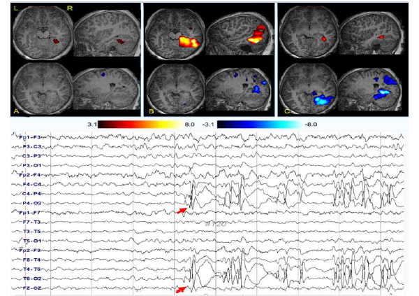 A) pre-spike map, B) peri-spike map, c) post-spike map