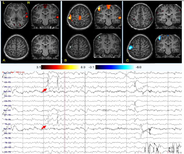 뇌전증 증후군에서 hemodynamic reponse pattern 변화 예시. A) pre-spike map, B) peri-spike map, c) post-spike map