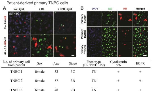 Triple negative breast cancer (TNBC) 환자로부터 획득한 primary cell에 대한 BL-PDT 효과. (A) Prrimary TNBC1에서 단백질 처리 후 생물발광 (BL) 및 LED에 의한 세포 사멸 효과. (B) Primary TNBC 1~3 에 대한 BL-PDT 효과 (SG: 사멸세포 검출용 시약)