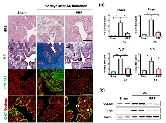 PRP치료한 mouse model 자궁내막 조직 H&E, Masson´s trichrome staining, fibrosis marker RT-PCR과 Western blotting결과상 유의하게 fibrosis marker들의 감소 소견을 보임