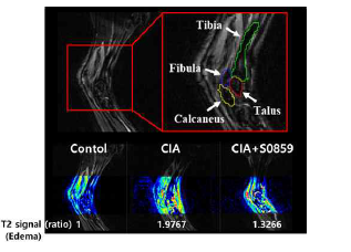 CIA 모델에서 MRI 부종수치비교