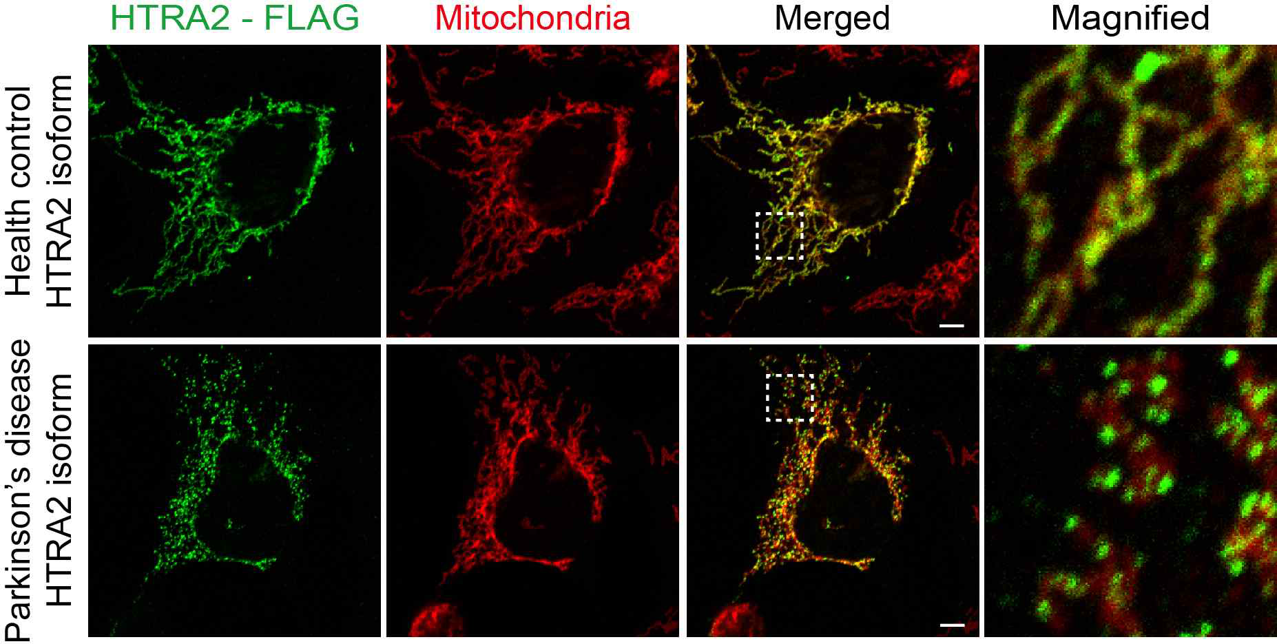 파킨슨병 특이적으로 발현되는 HTRA2 splicing isoform의 protein aggregation